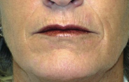 Acne Scars Before & After Patient #1638