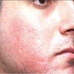 Acne Scars Before & After Patient #1639