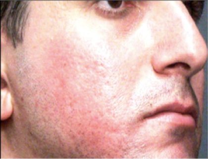 Acne Scars Before & After Patient #1639