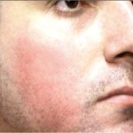 Acne Scars Before & After Patient #1639