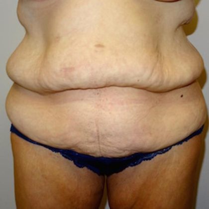 After Weight Loss Before & After Patient #1525