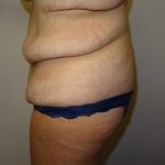 After Weight Loss Before & After Patient #1525