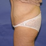 After Weight Loss Before & After Patient #1525