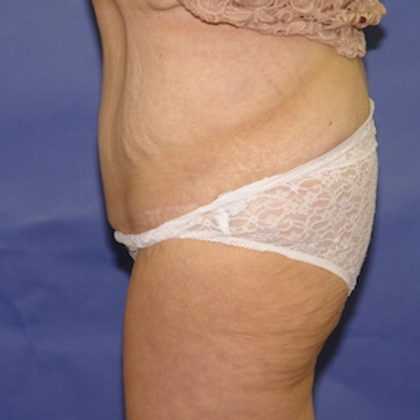 After Weight Loss Before & After Patient #1525