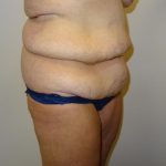 After Weight Loss Before & After Patient #1525