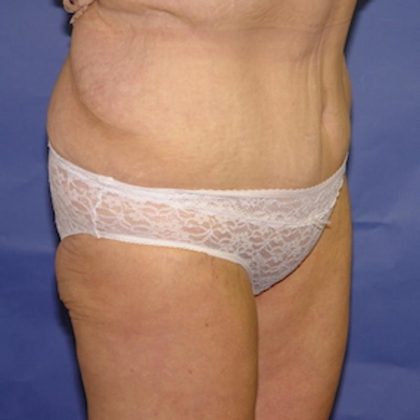 After Weight Loss Before & After Patient #1525