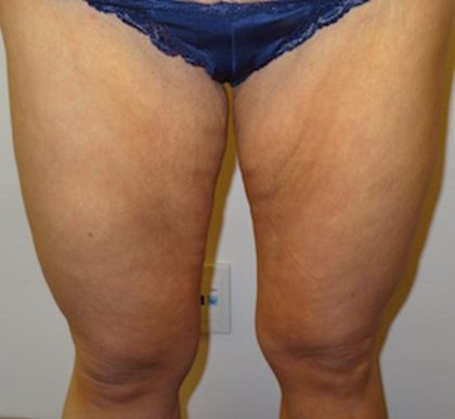 After Weight Loss Before & After Patient #1525