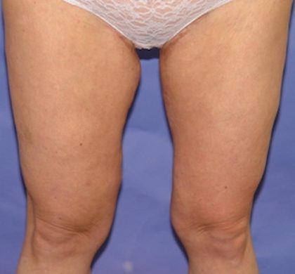 After Weight Loss Before & After Patient #1525