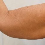Arm Lift Before & After Patient #731