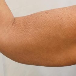 Arm Lift Before & After Patient #731