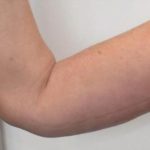 Arm Lift Before & After Patient #731