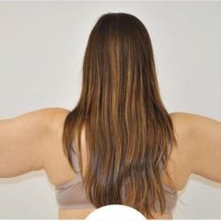 Arm Lift Before & After Patient #732
