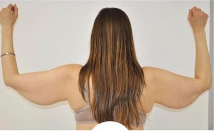 Arm Lift Before & After Patient #732
