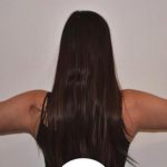 Arm Lift Before & After Patient #732