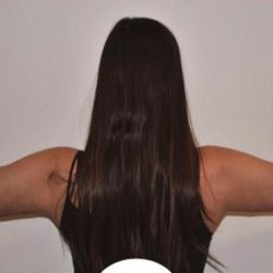Arm Lift Before & After Patient #732
