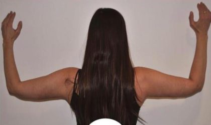 Arm Lift Before & After Patient #732