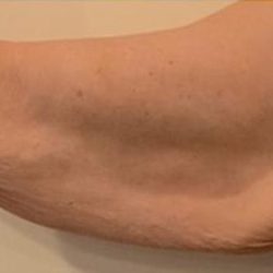 Arm Lift Before & After Patient #733