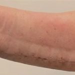 Arm Lift Before & After Patient #733