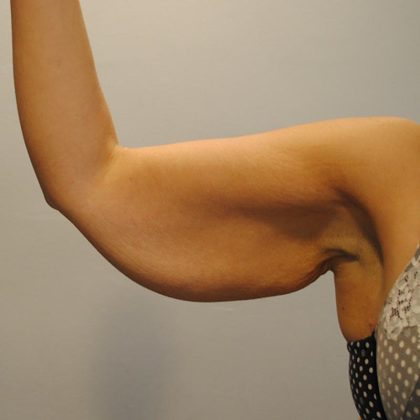 Arm Lift Before & After Patient #754
