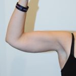 Arm Lift Before & After Patient #754