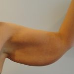 Arm Lift Before & After Patient #754