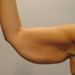 Arm Lift Before & After Patient #754