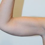 Arm Lift Before & After Patient #754