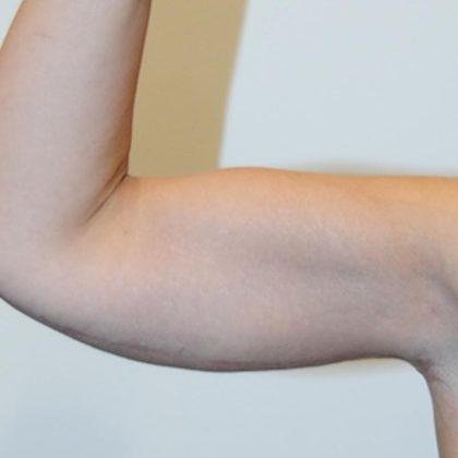 Arm Lift Before & After Patient #754