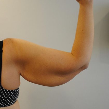 Arm Lift Before & After Patient #754