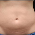 Body Countoring Before & After Patient #765