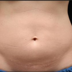 Body Countoring Before & After Patient #765
