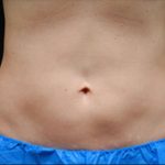 Body Countoring Before & After Patient #765