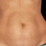Body Countoring Before & After Patient #766