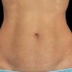 Body Countoring Before & After Patient #766
