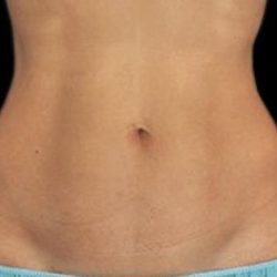 Body Countoring Before & After Patient #766