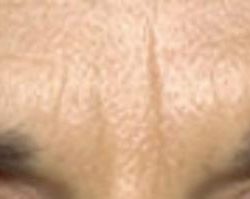 Neuromodulators Before & After Patient #1558