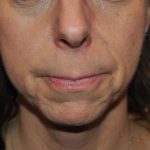 Neuromodulators Before & After Patient #1559