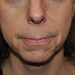 Neuromodulators Before & After Patient #1559