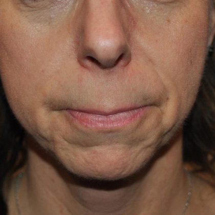 Botox Before & After Patient #1559