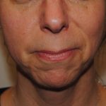 Neuromodulators Before & After Patient #1559