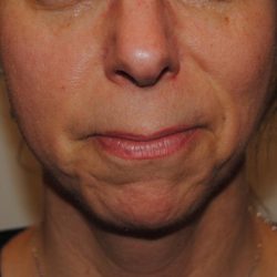 Neuromodulators Before & After Patient #1559