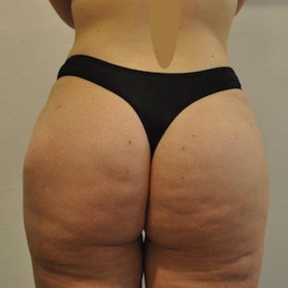 Brazilian Buttock Augmentation Before & After Patient #1526