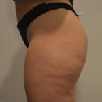 Brazilian Buttock Augmentation Before & After Patient #1526