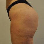 Brazilian Buttock Augmentation Before & After Patient #1526