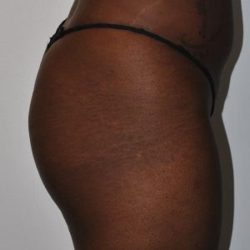 Brazilian Buttock Augmentation Before & After Patient #1527
