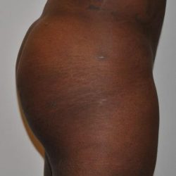 Brazilian Buttock Augmentation Before & After Patient #1527