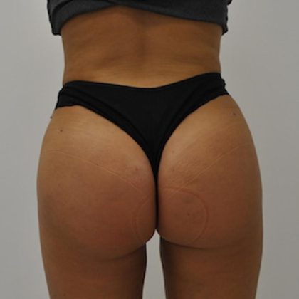 Brazilian Buttock Augmentation Before & After Patient #1528
