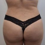 Brazilian Buttock Augmentation Before & After Patient #1530