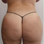 Brazilian Buttock Augmentation Before & After Patient #1530
