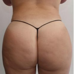 Brazilian Buttock Augmentation Before & After Patient #1530
